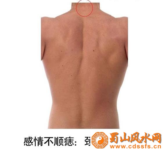 颈后中侧若生有胎记