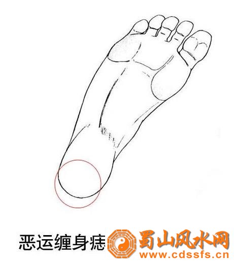 脚后跟有胎记